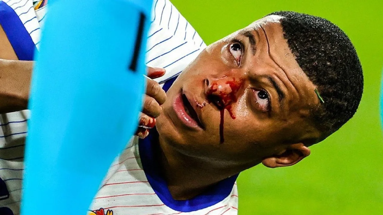 Mbappé no será operado de la fractura en el tabique y jugaría ante Países Bajos